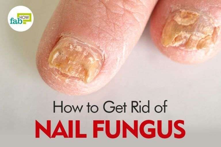 how to get rid of nail fungus
