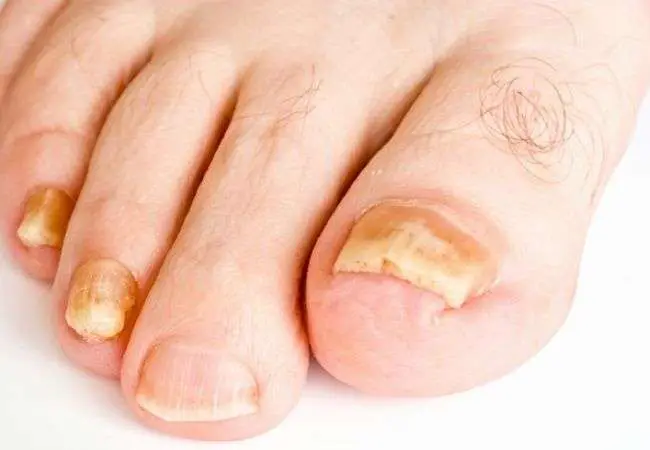 How To Get Rid Of Thick Toe Nails