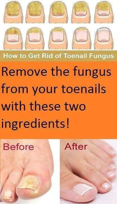 How to Get Rid of Toenail Fungus Fast and Naturally in ...