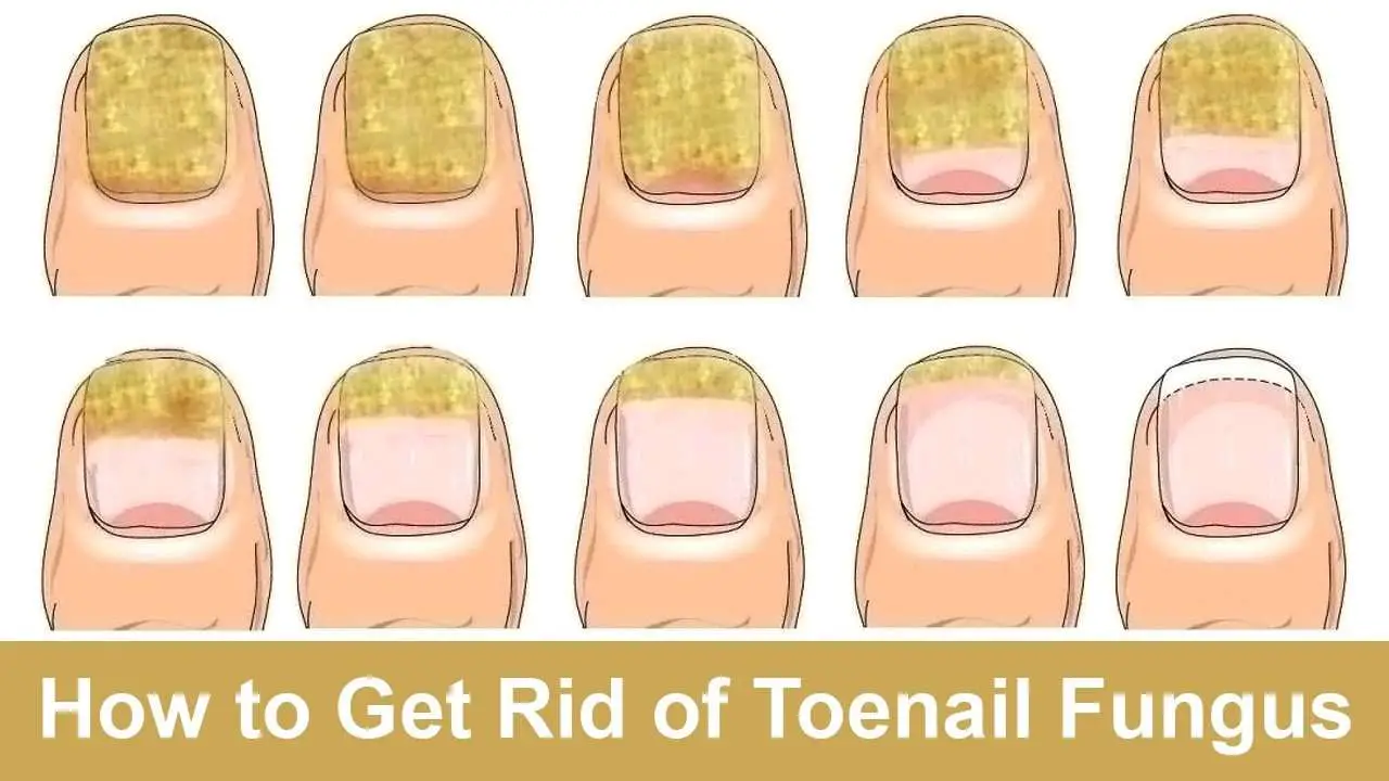 How to Get Rid of Toenail Fungus Fast and Naturally