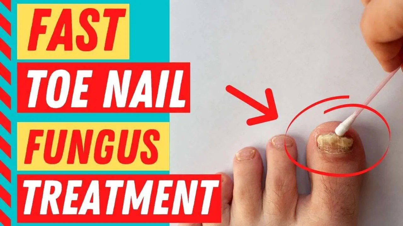 How To Get Rid Of Toenail Fungus Fast