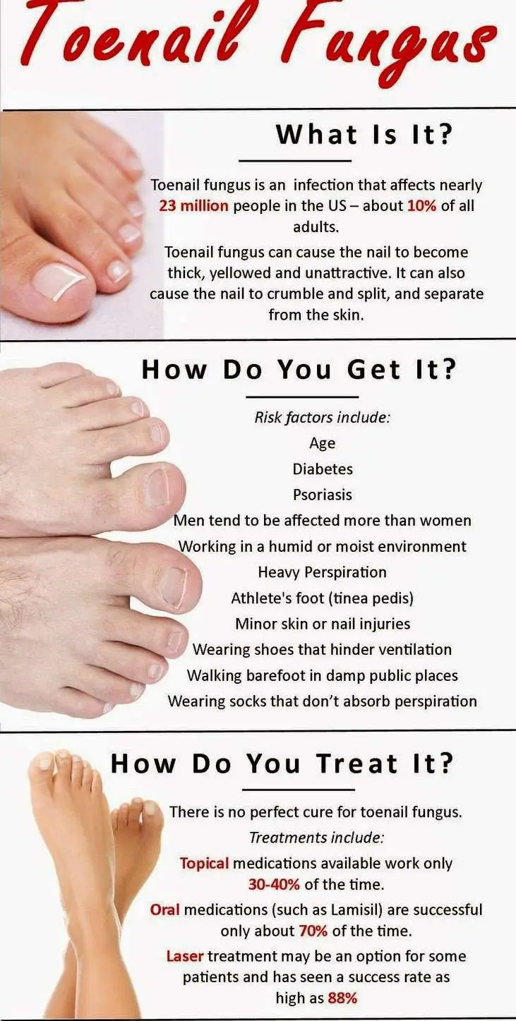 How To Get Rid Of Toenail Fungus In 2020 Expert Information