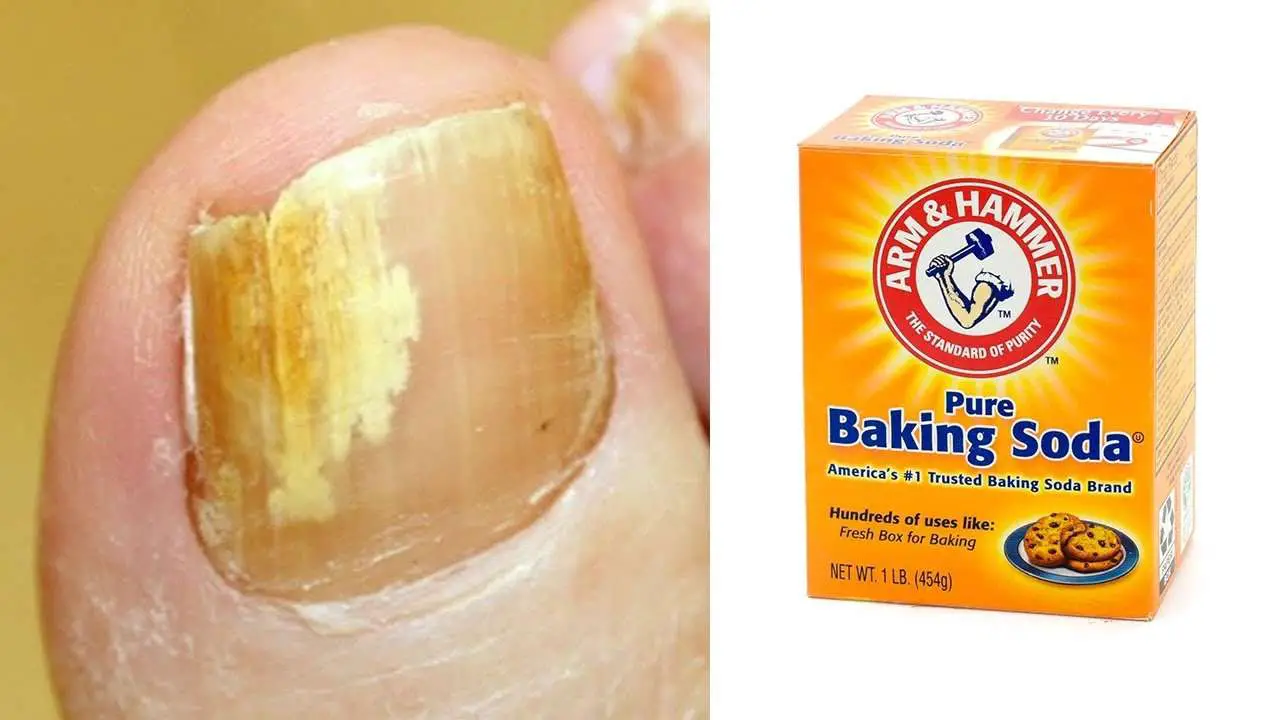 How to get rid of toenail fungus naturally fast in 2 day ...