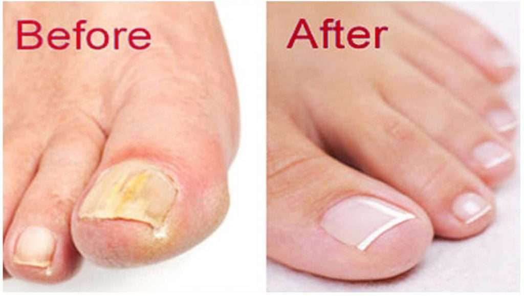 How To Get Rid Of Toenail Fungus Naturally With 5 Proven ...