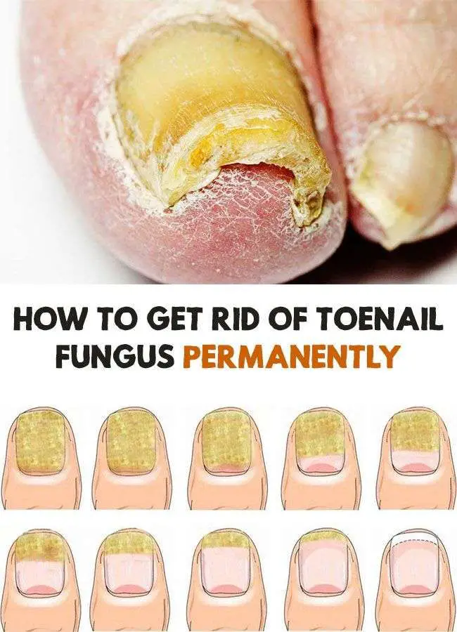 How to Get Rid of Toenail Fungus Permanently # ...