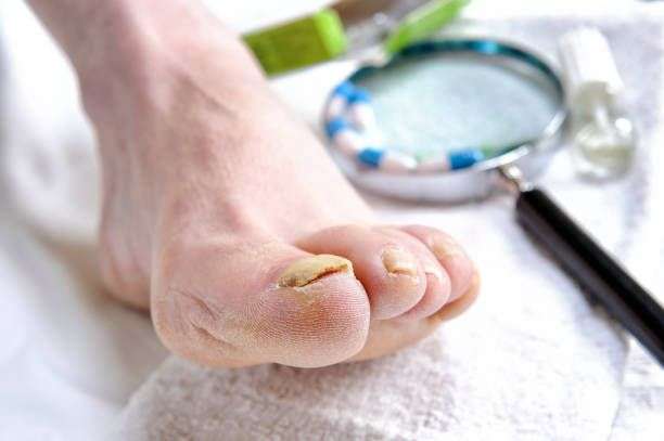 How To Get Rid Of Toenail Fungus With Apple Cider Vinegar ...