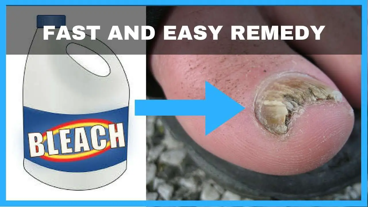 how to get rid of toenail fungus with bleach mishkanet com