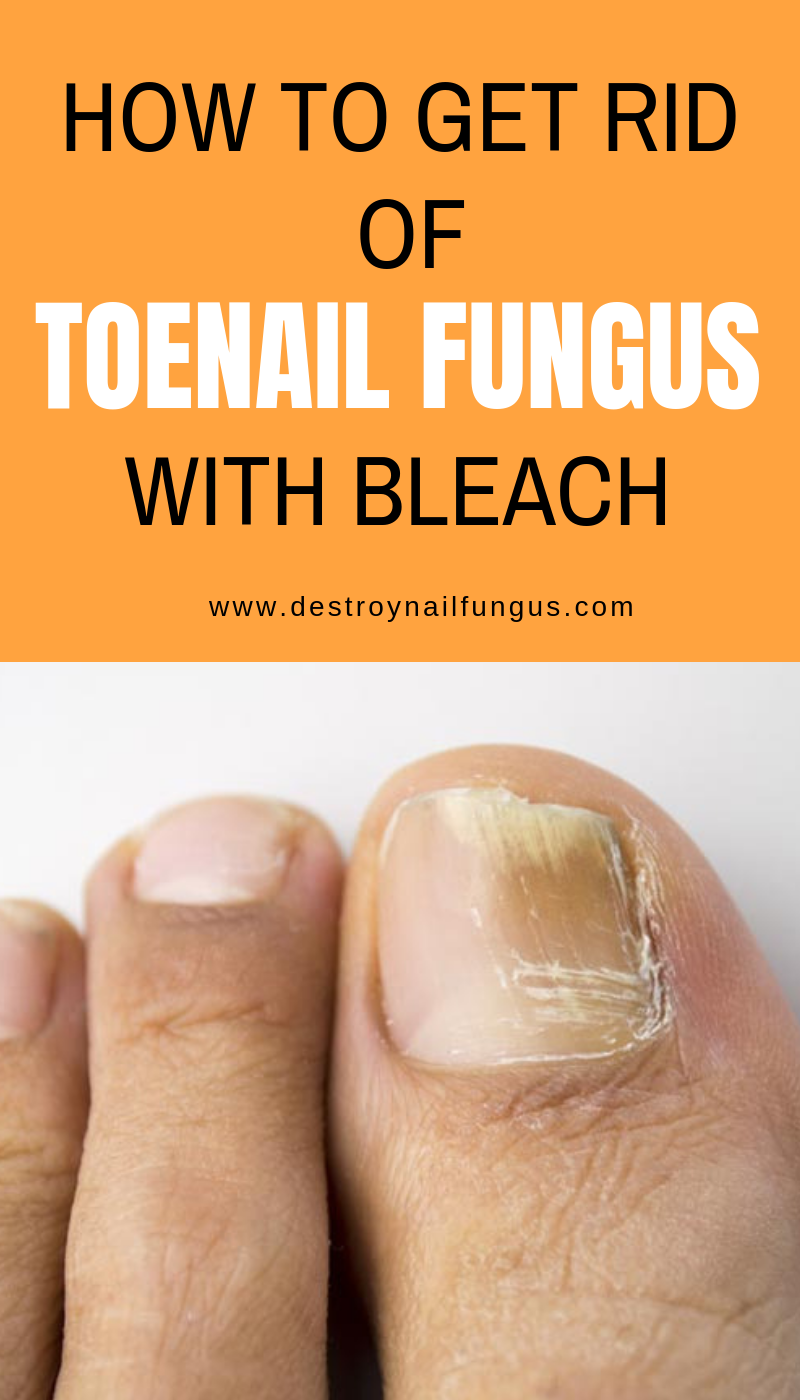 how to get rid of toenail fungus with bleach mishkanet com