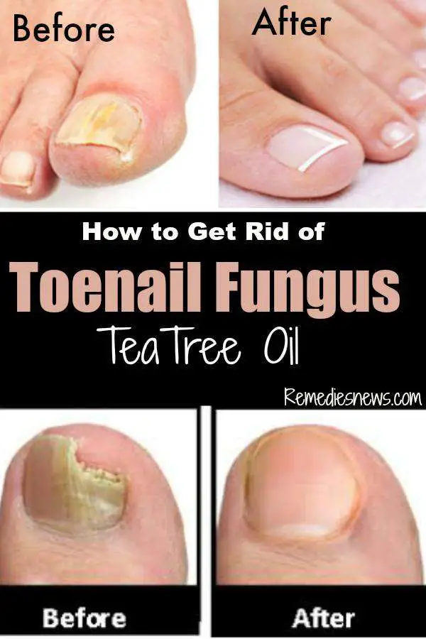 How to Get Rid of Toenail Fungus with Tea Tree Oil (Fast Remedy)