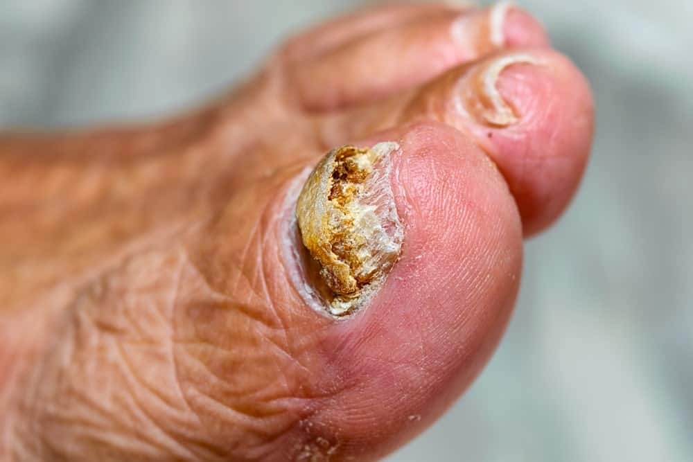How to Give Yourself the Perfect Pedicure with Toenail Fungus
