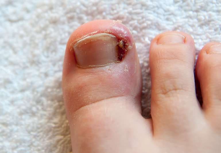 How to Prevent and Treat Ingrown Toenails  Health ...