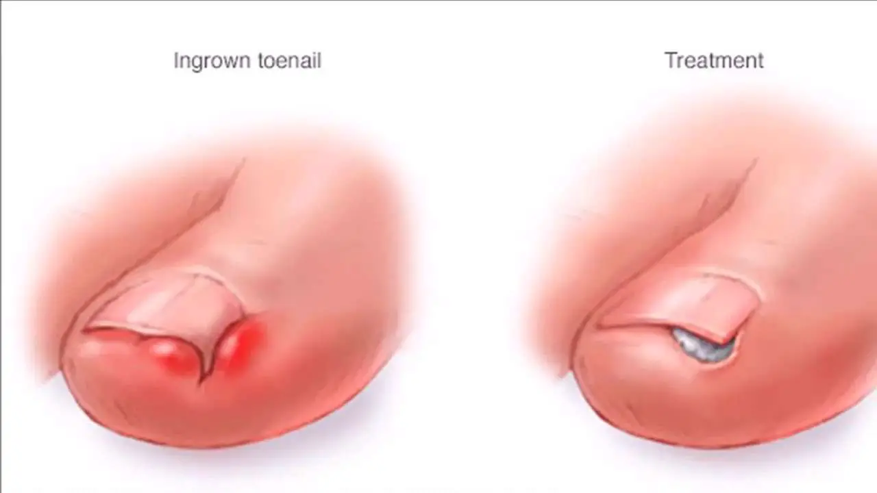 How to Remove a Ingrown Toenail Completely Naturally ...