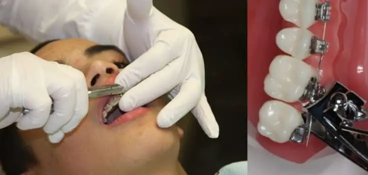 How to Remove Braces With Nail Clippers in 8 Easy Ways (2021)