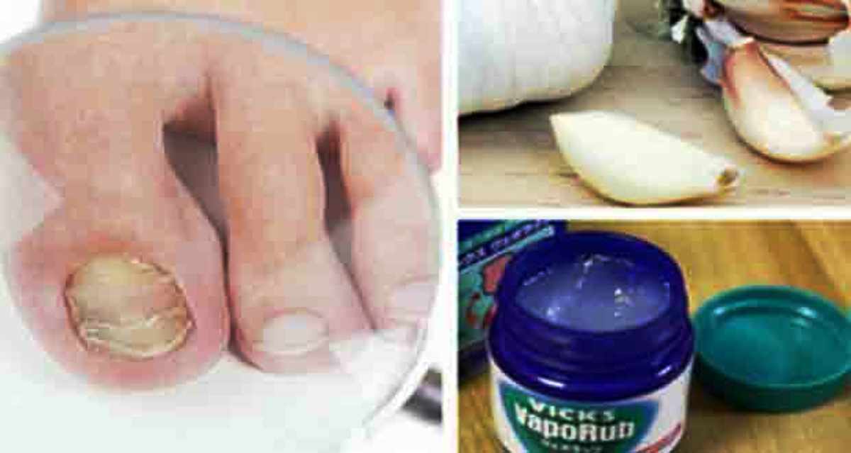 How to Remove Nail Fungus