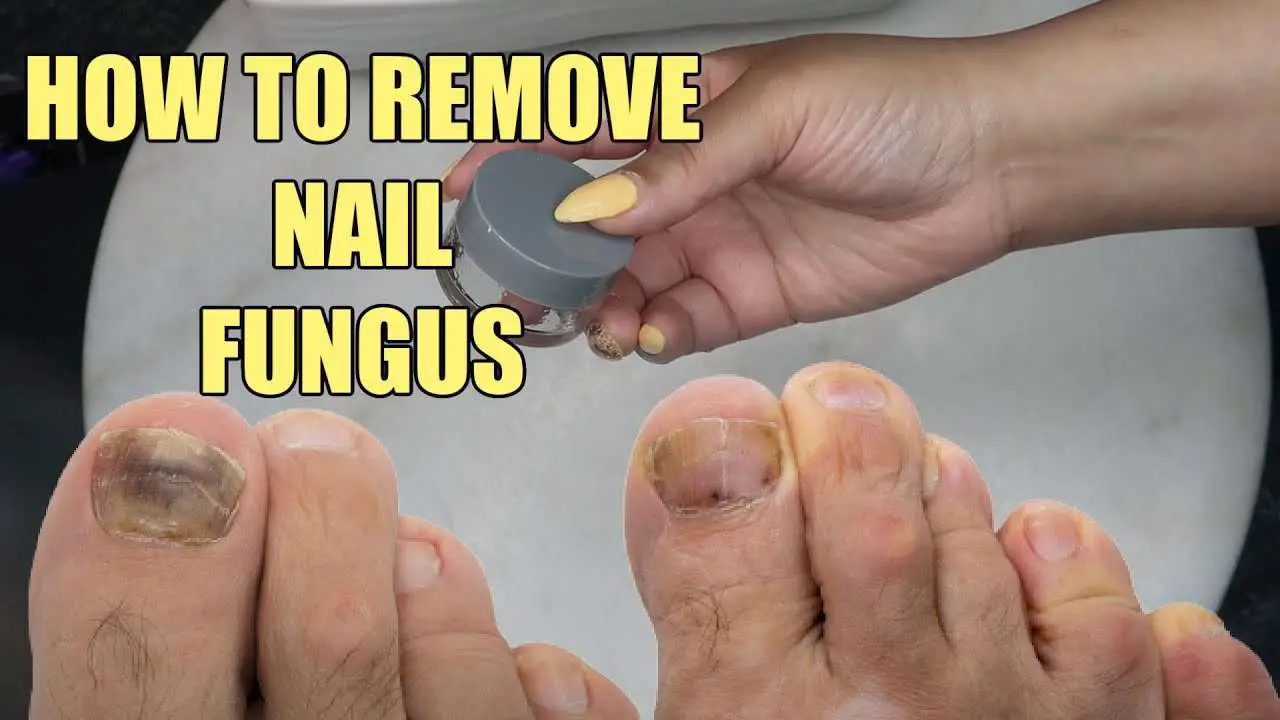 HOW TO REMOVE NAIL FUNGUS
