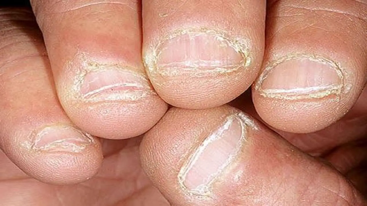 How to Treat Peeling Nails: Best Nail Treatment For ...