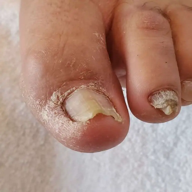 How To Treat Toenail Fungus With ZetaClear Â» NCH