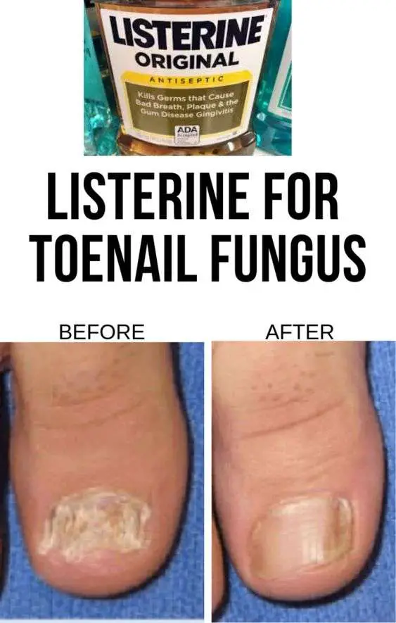 HOW TO USE LISTERINE FOR TOENAIL FUNGUS EFFORTLESSLY ...