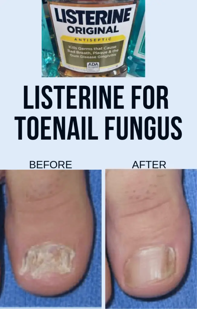 How To Use Listerine For Toenail Fungus Effortlessly # ...