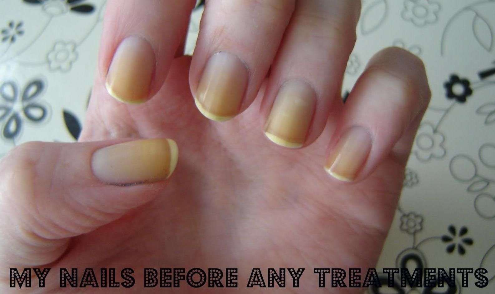 How To Whiten Yellow Nails: Simple Home Remedies That Work ...