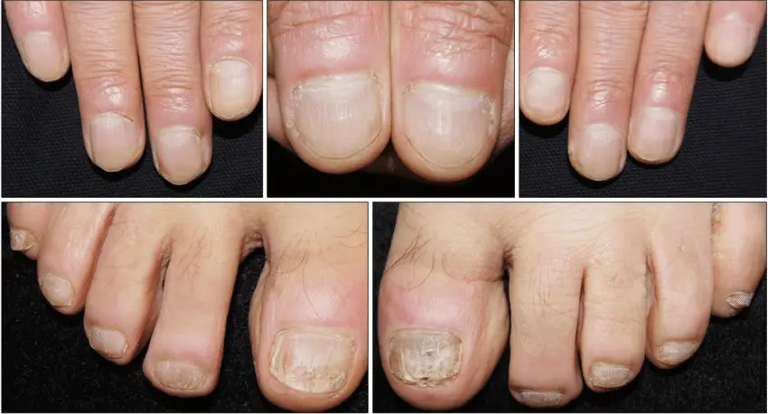 Improvement in nail psoriasis after the fourth injection ...