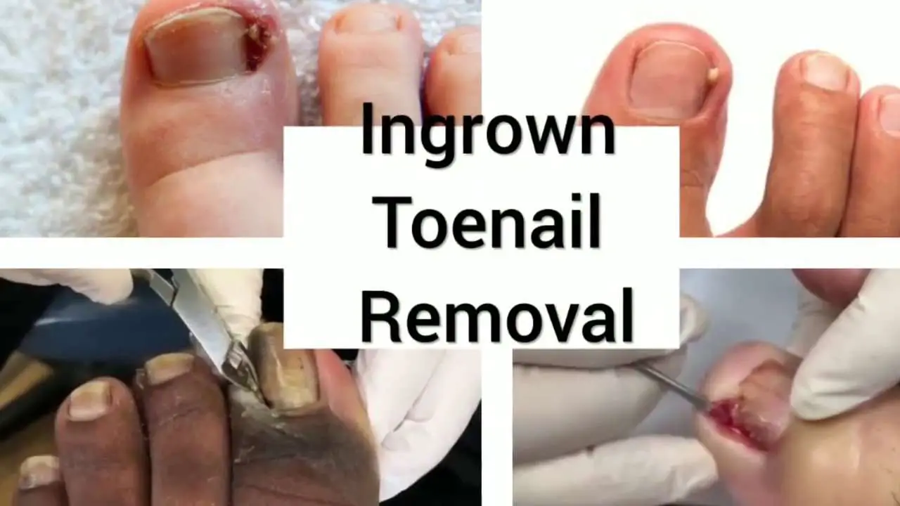 Ingrown toenail remove