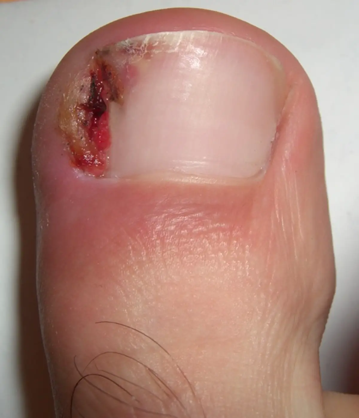 Ingrown toenails infection