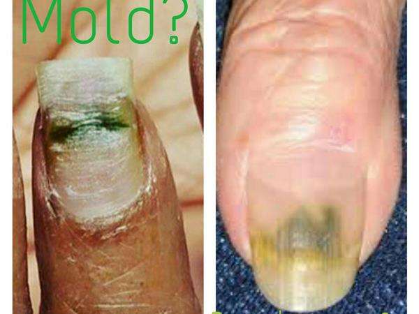 Is that green nail,mold or fungus? 04/10 by Team Nail Talk ...