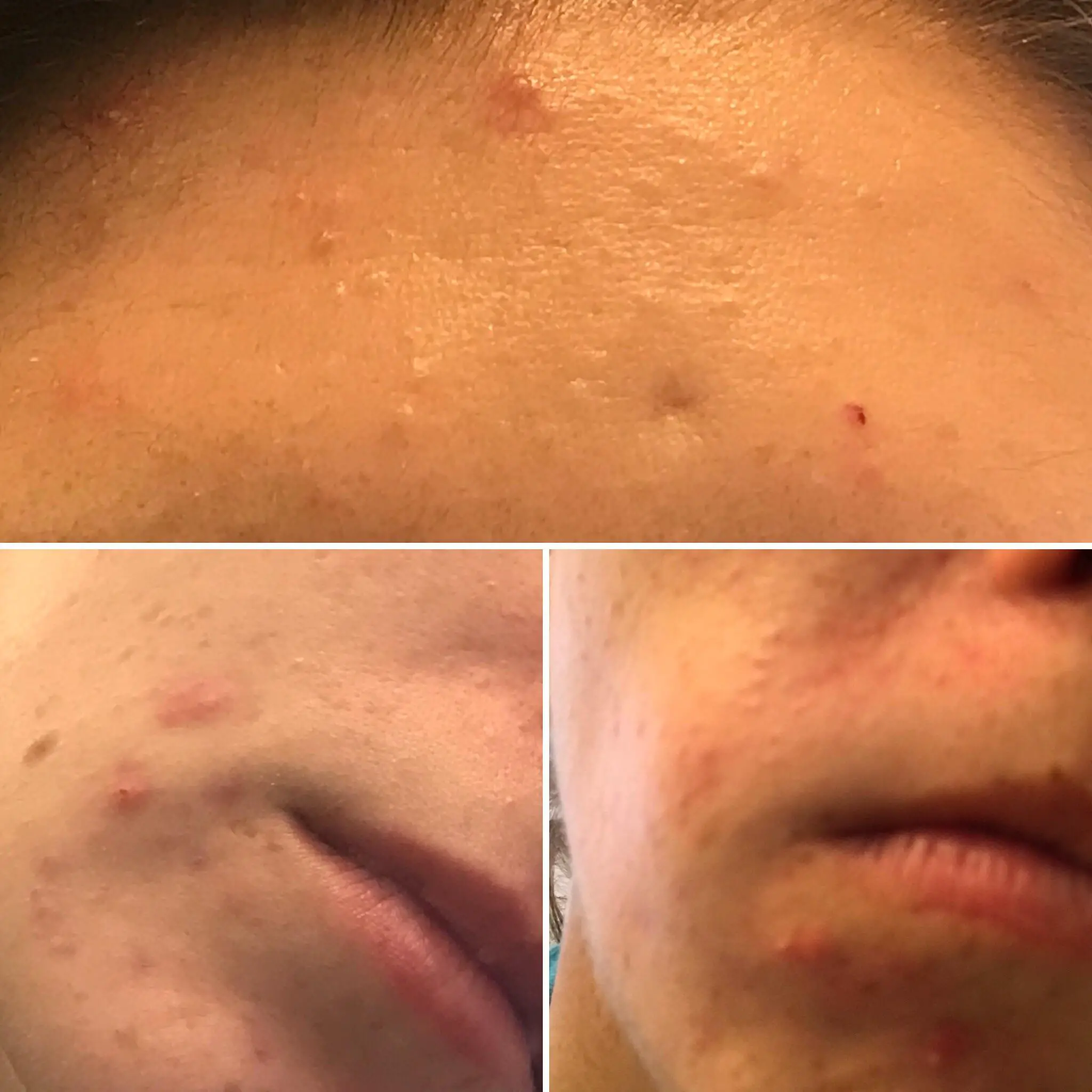 Is this fungal acne? Have tried everything. Please help! Routine in ...