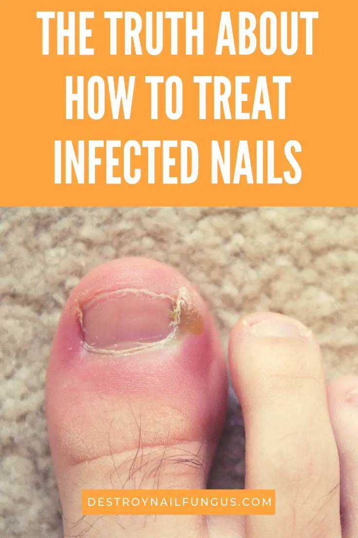 It is surprisingly easy to get an infection of your nails ...