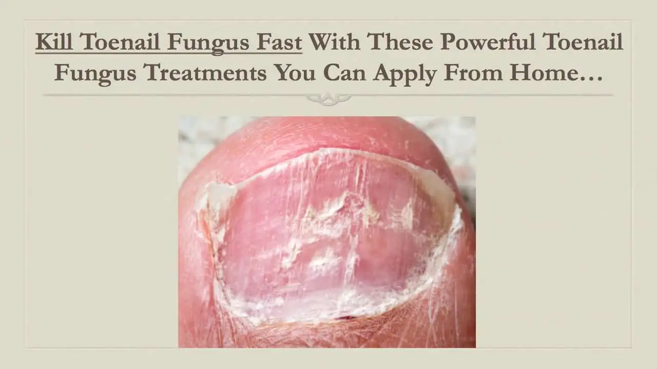 Kill Toenail Fungus Fast With This Powerful Toenail Fungus ...