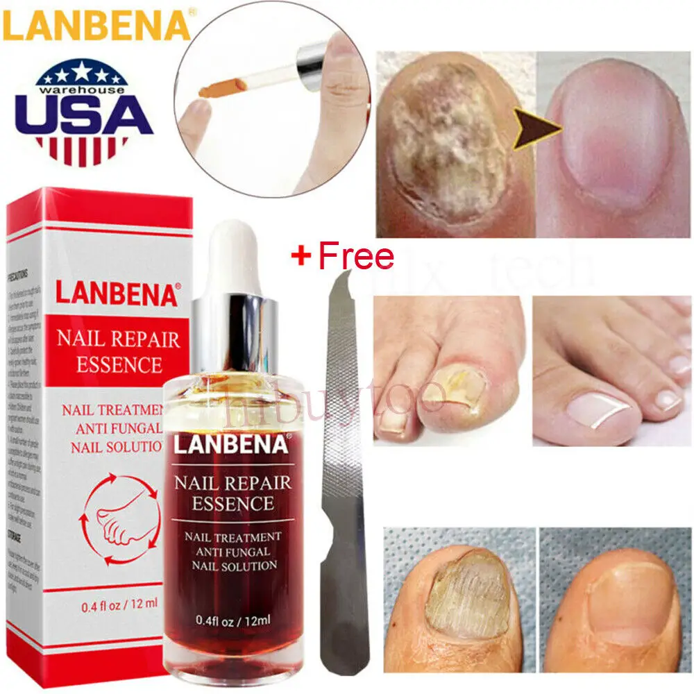 LANBENA Anti Fungal Nail Treatment Finger Toe Care Nail Fungus ...