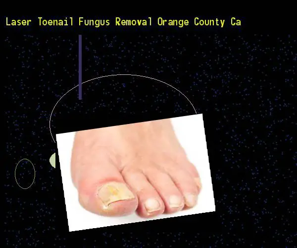 Laser toenail fungus removal orange county ca