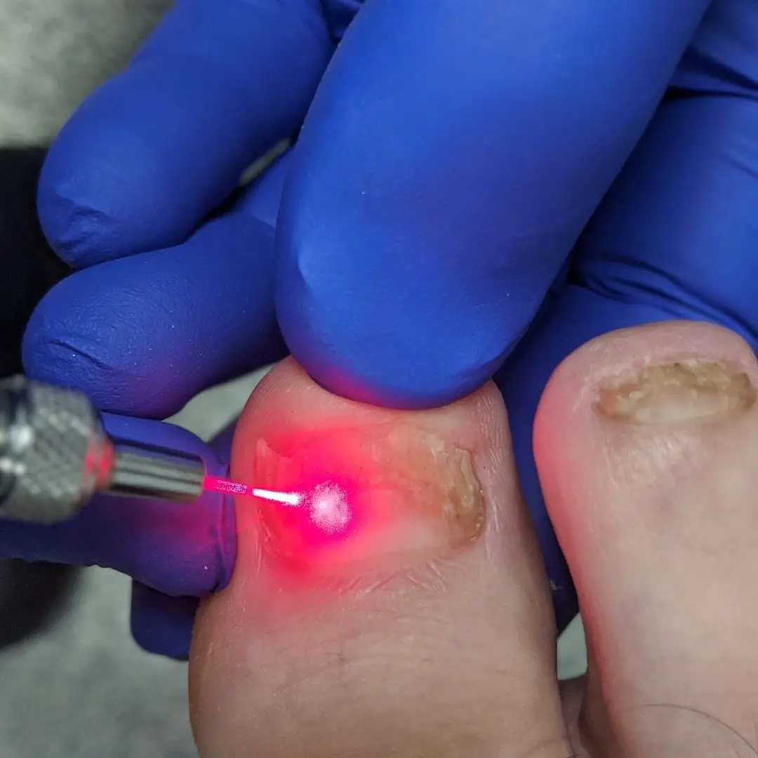 Laser Treatment For Nail Fungus Infection