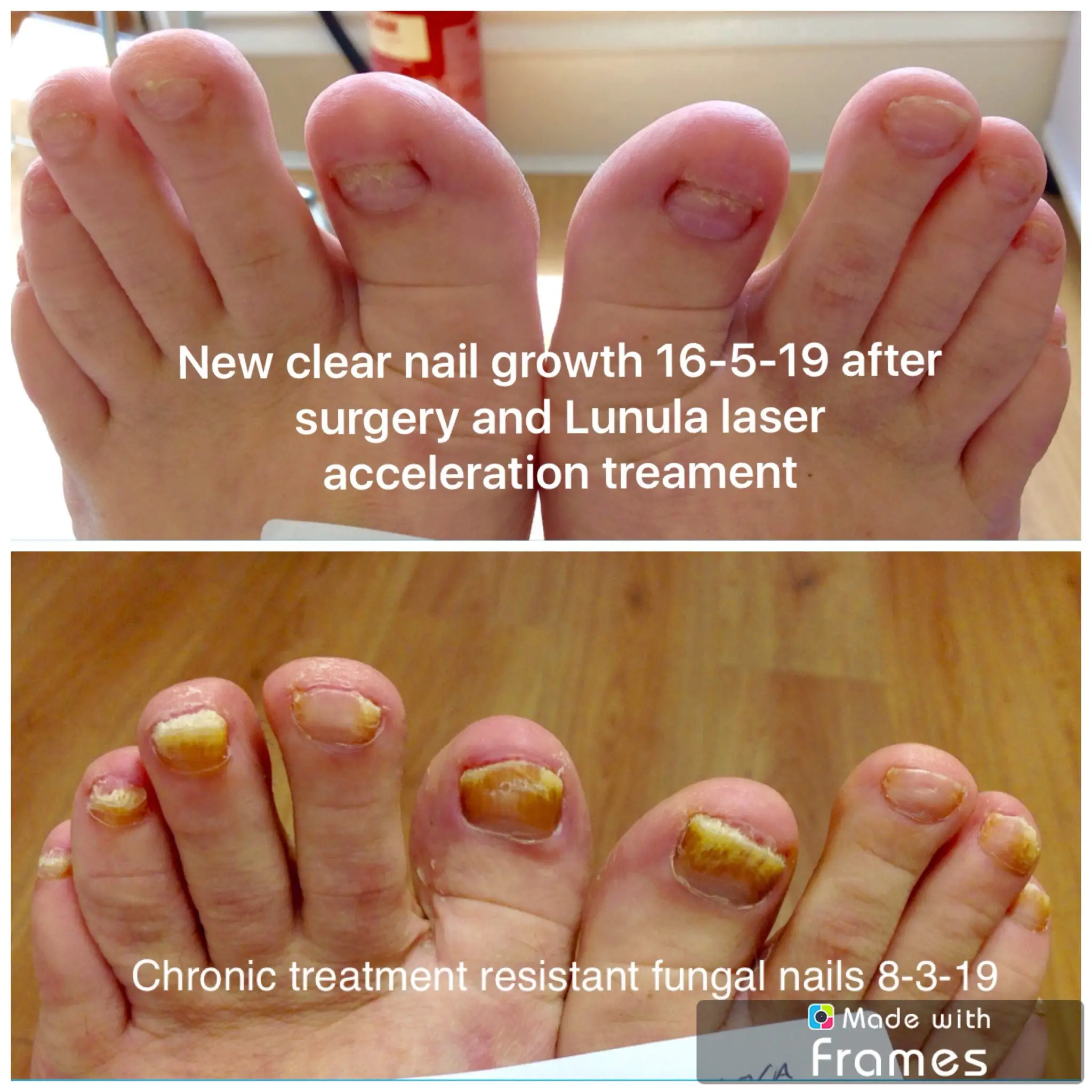 Laser Treatment For Toenail Fungus Covered By Insurance