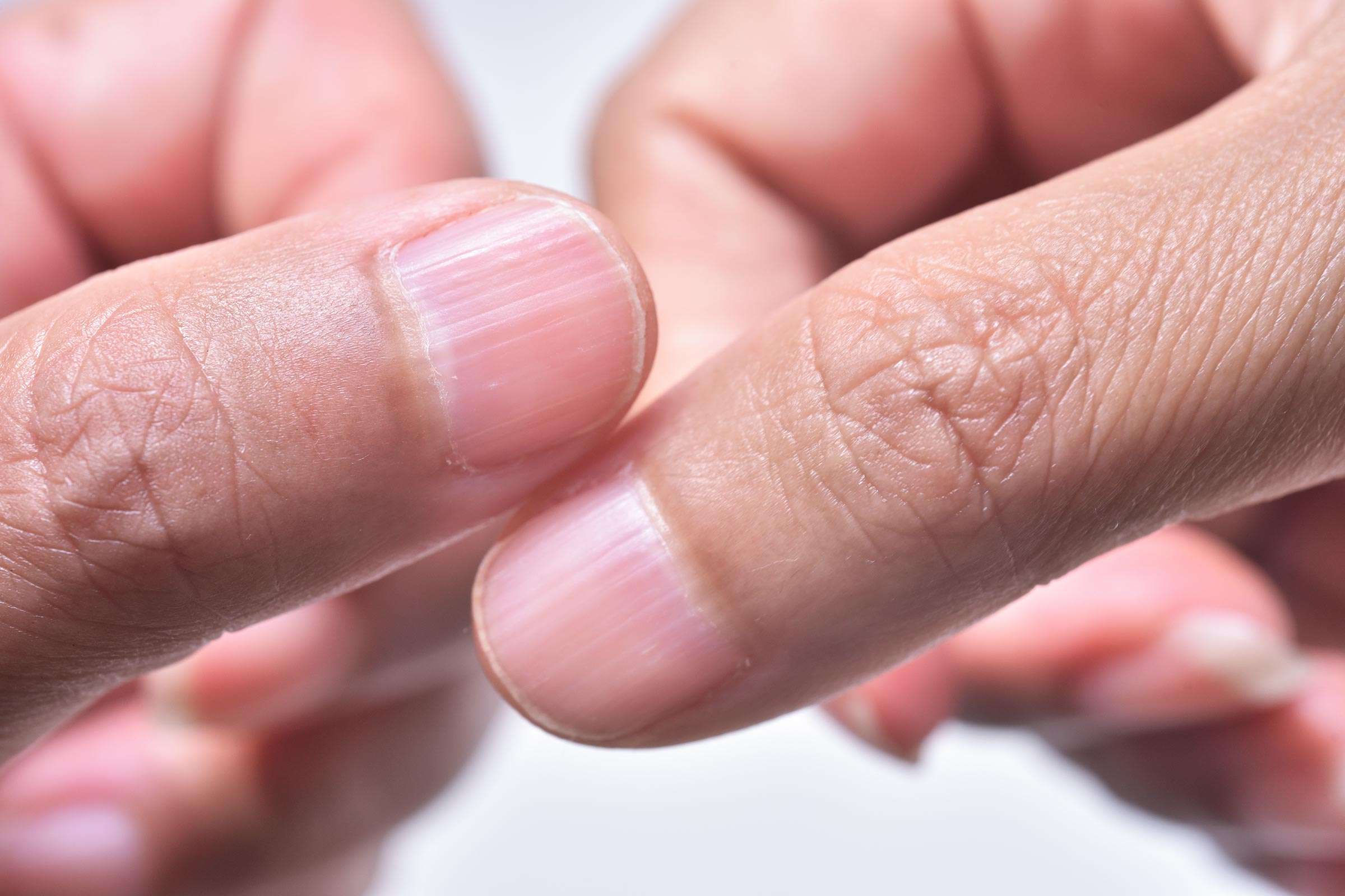 Lines On Your Fingernails, Do You Have Them? What Do They ...