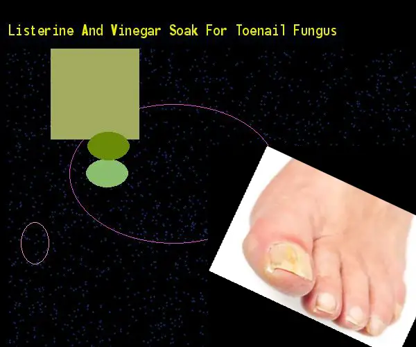 Listerine and vinegar soak for toenail fungus