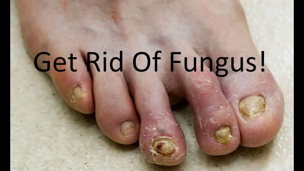 Listerine for Foot &  Toenail Fungus