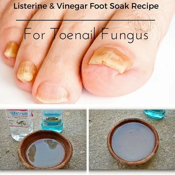 Listerine &  Vinegar Foot Soak Recipe For Toenail Fungus, Calluses, Dead ...