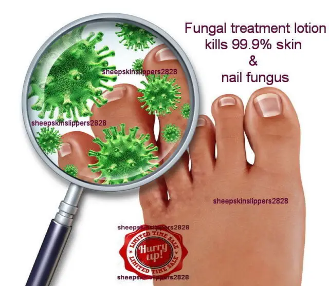 Miracle Fungal Treatment Lotion Kills 99.9 Skin Nail Fungus Toes Care ...