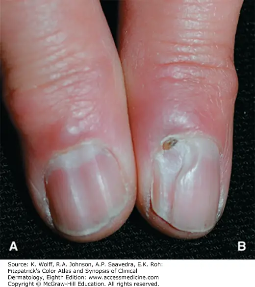 Nail Avulsion Icd 10 ~ 18 Browse through the largest collection of ...