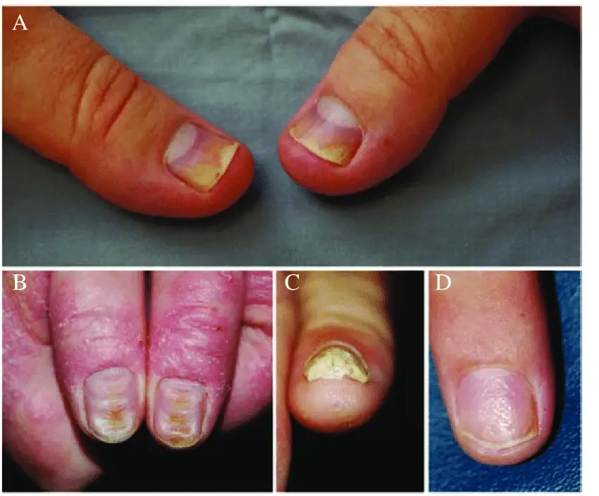 Nail changes in psoriatic arthritis (PsA): (A) onycholysis  (B ...