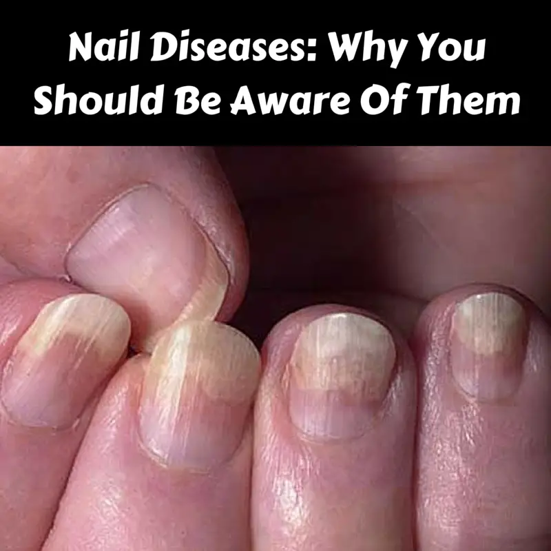 Nail Diseases: Why You Should Be Aware Of Them