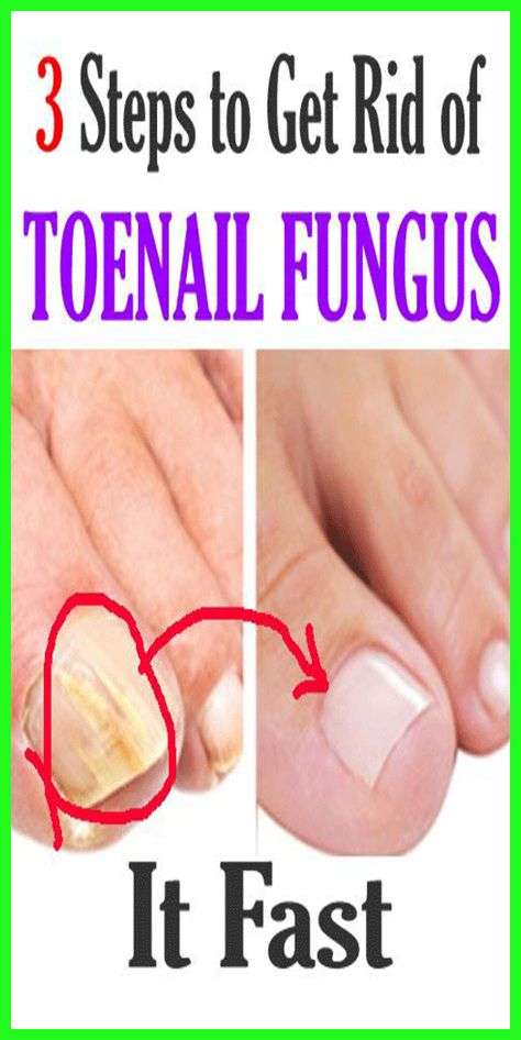 Nail Fungus Can Be Dangerous Remove This By Using Recipe ...