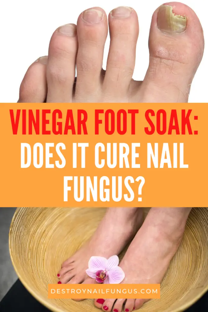 Nail Fungus Remedy Guide: How Does Vinegar Kill Fungus?