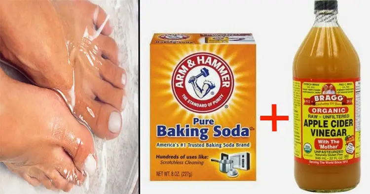 Nail Fungus Remedy with Baking Soda and Apple Cider Vinegar