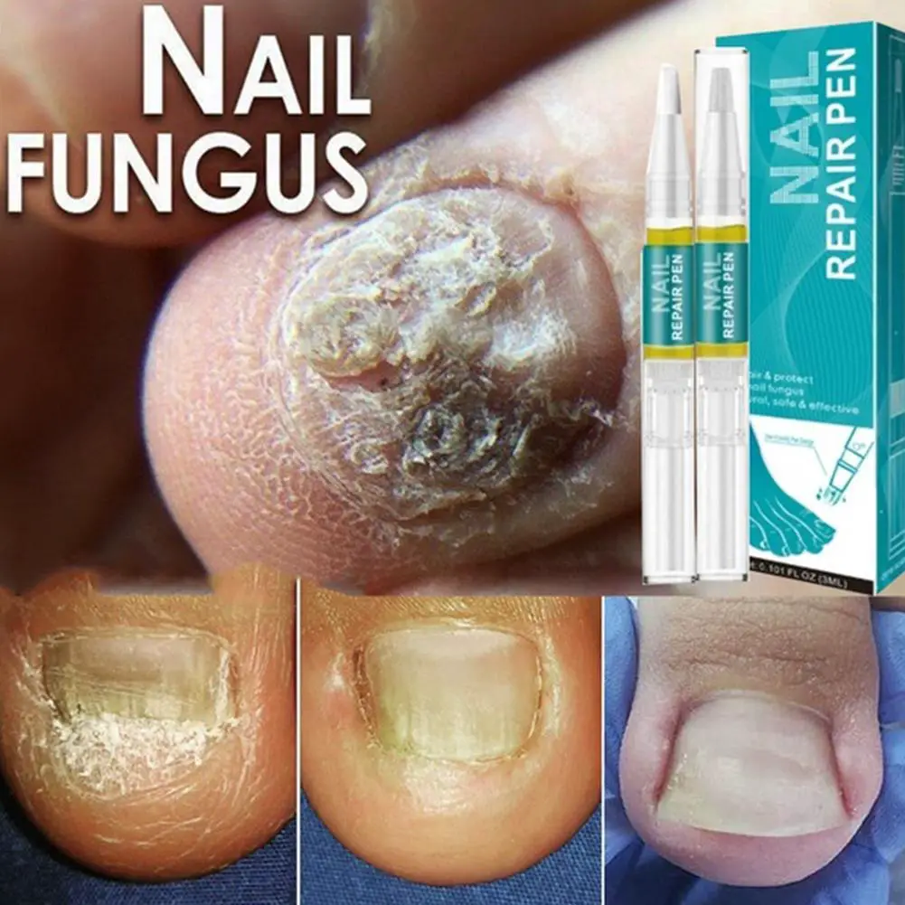 Nail Fungus Repair Treatment Pen Products Onychomycosis Paronychia Anti ...