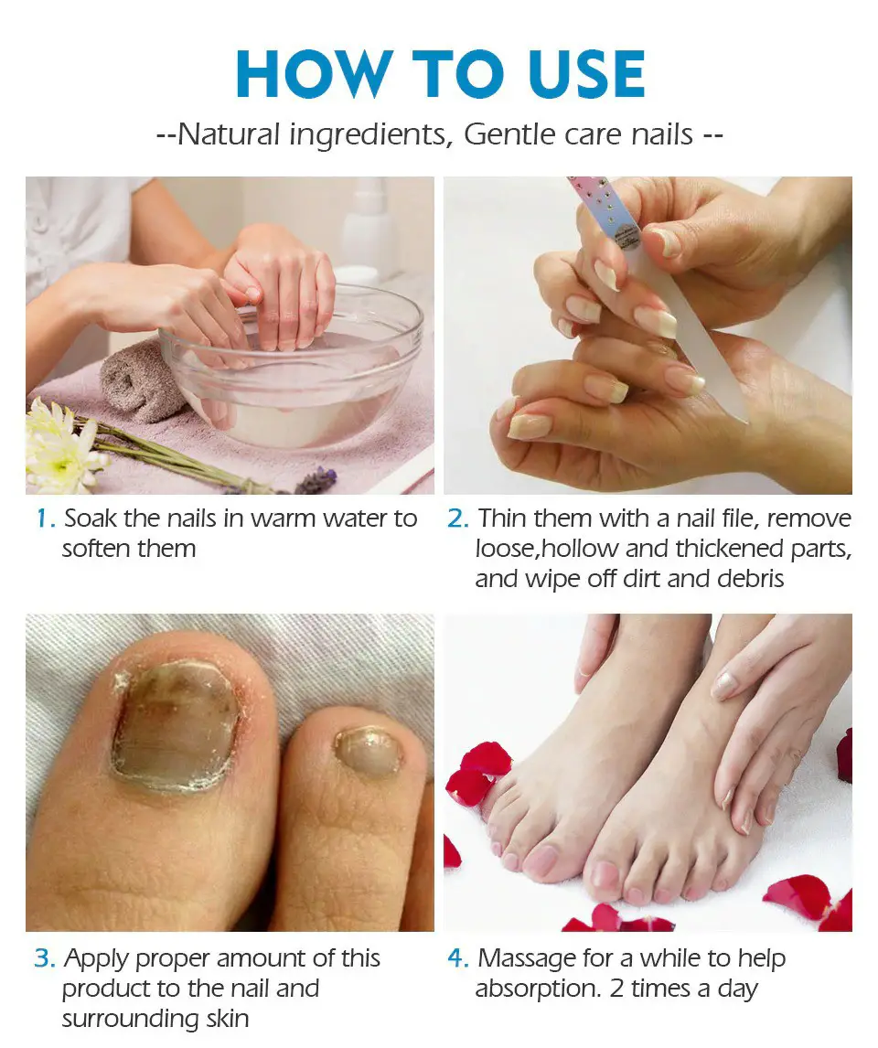 Nail Fungus Treatment Toe, Foot Finger Nail Fungal Infections Natural ...