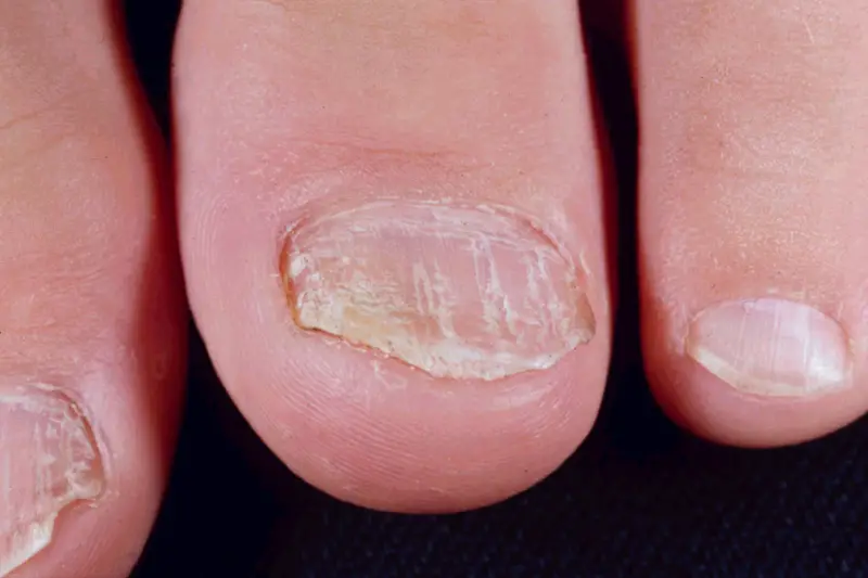 Nail psoriasis photos on the hands
