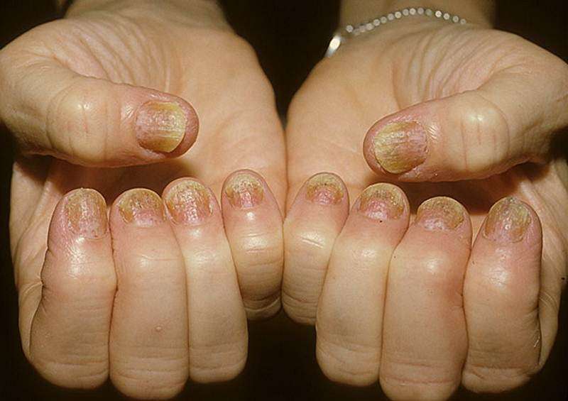 Nail psoriasis pictures